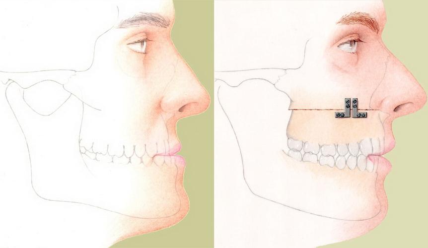 Удлиненная челюсть. Операция остеотомия верхней челюсти. Остеотомия дистальный прикус. Сегментарная остеотомия челюсти. Остеотомия верхней и нижней челюсти.