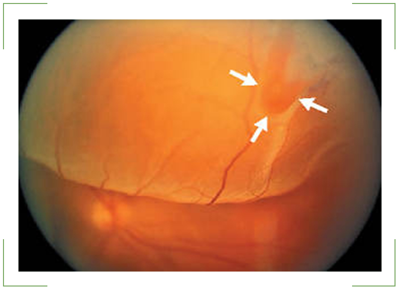 Отслойка сетчатки причины. Неопластическая отслойка сетчатки. Нерегматогенная отслойка сетчатки. Свежая регматогенная отслойка сетчатки. Регматогенная отслойка сетчатки офтальмоскопия.