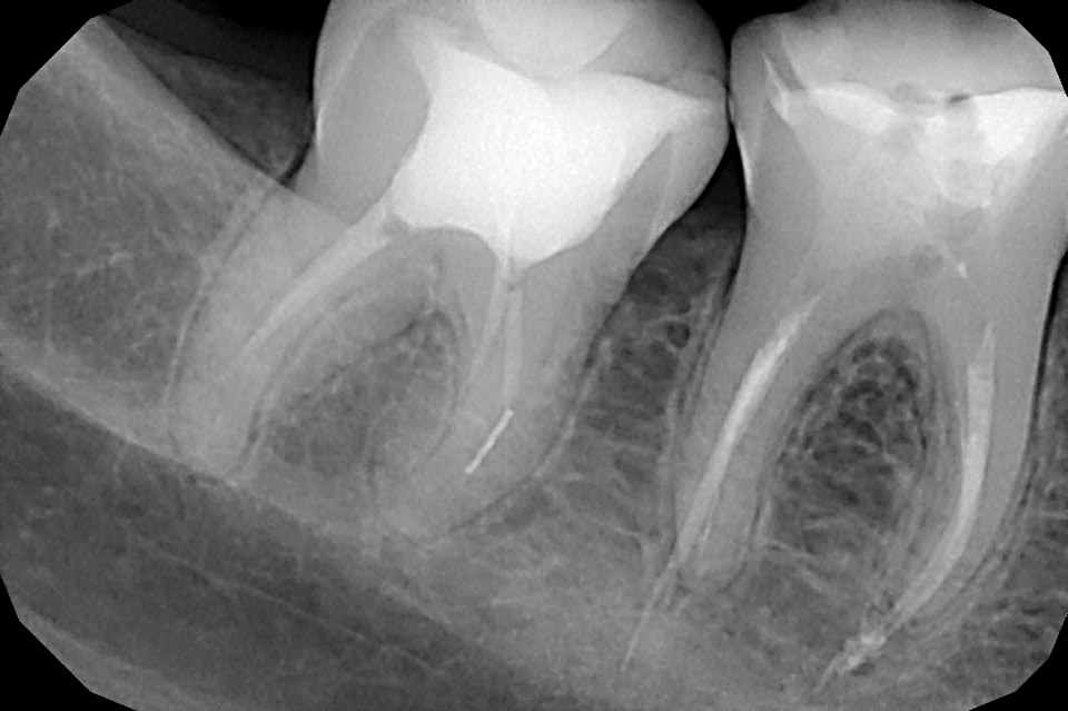После удаления нерва болит зуб
