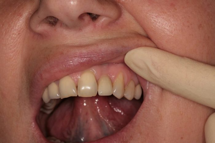 Болит передний зуб
