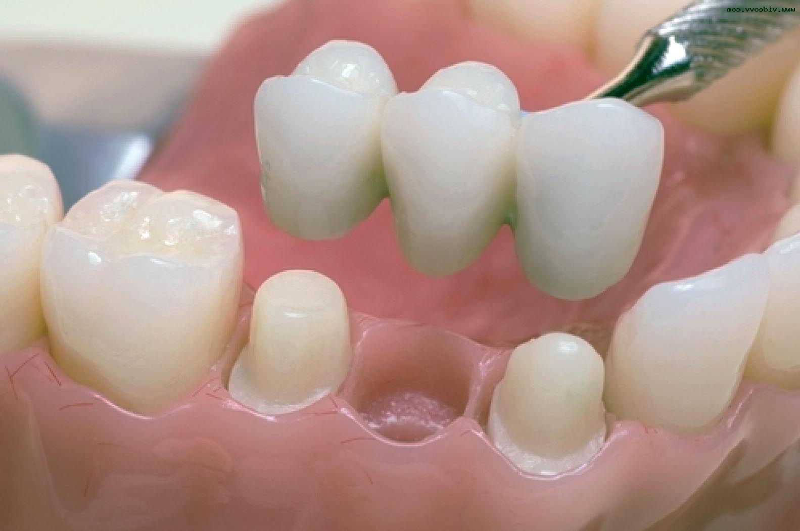 Мостовидные несъемные зубные протезы