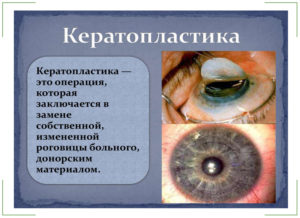 Эндотелиальная дистрофия роговицы глаза (синдром Фукса)
