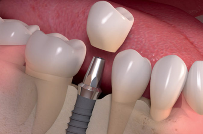 Удаление импланта зуба и показания к проведению операции