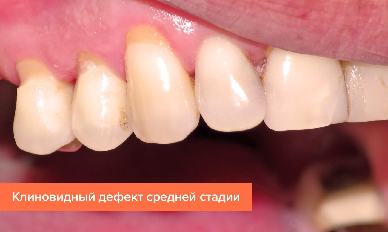дефект зубов