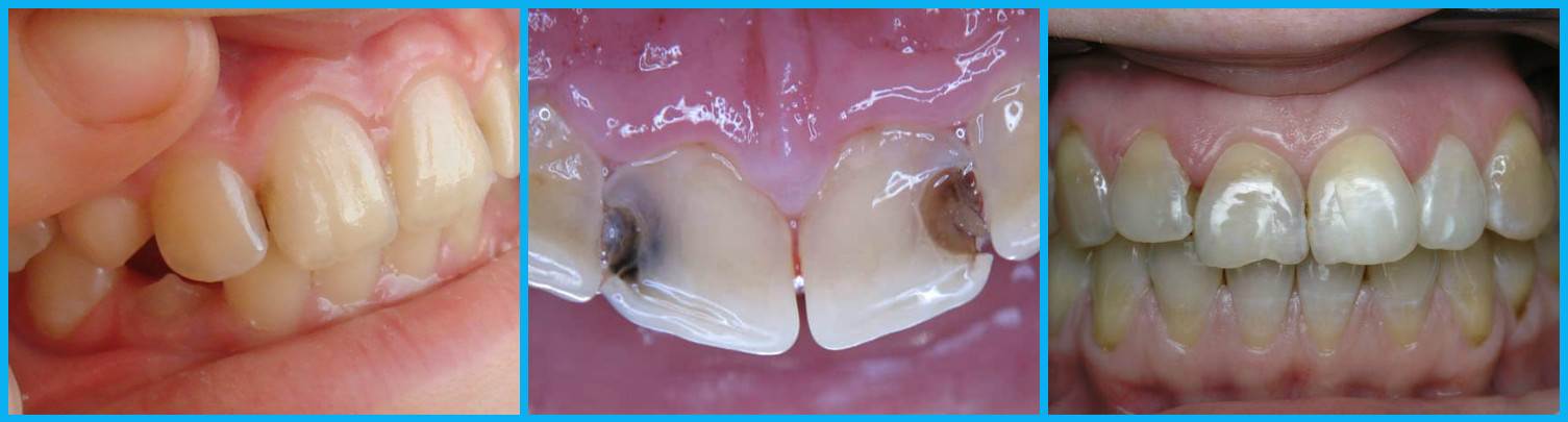 Что делать при появлении кариеса между зубами?