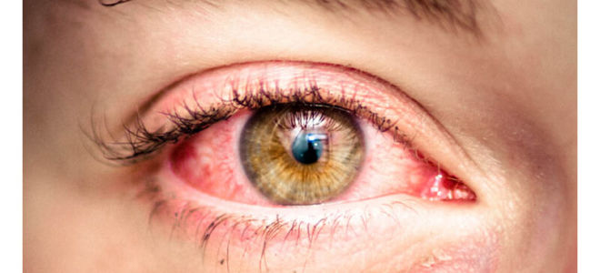 Красные глаза после сна
