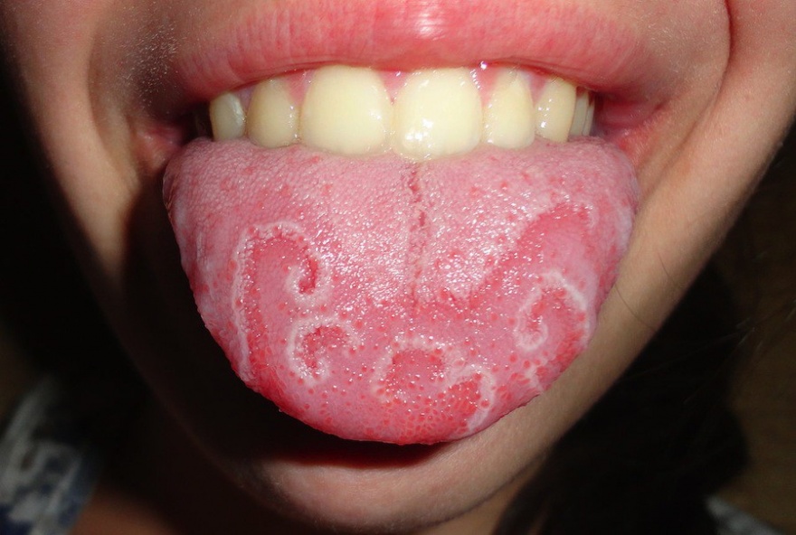 Заболевания полости рта