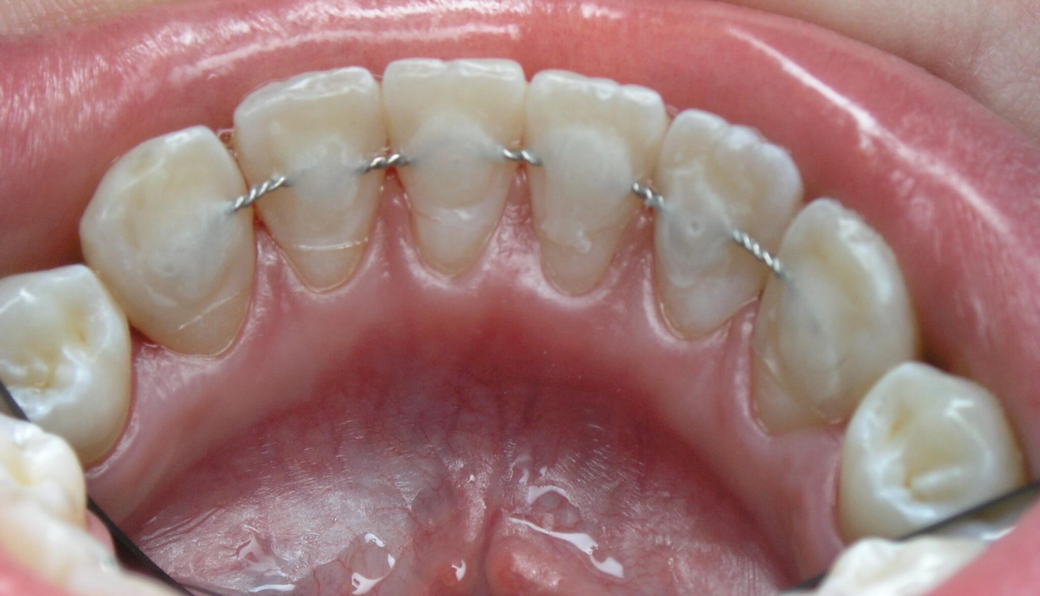 Шинирование зубов: что это такое