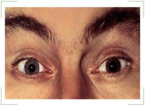 Эндотелиальная дистрофия роговицы глаза (синдром Фукса)