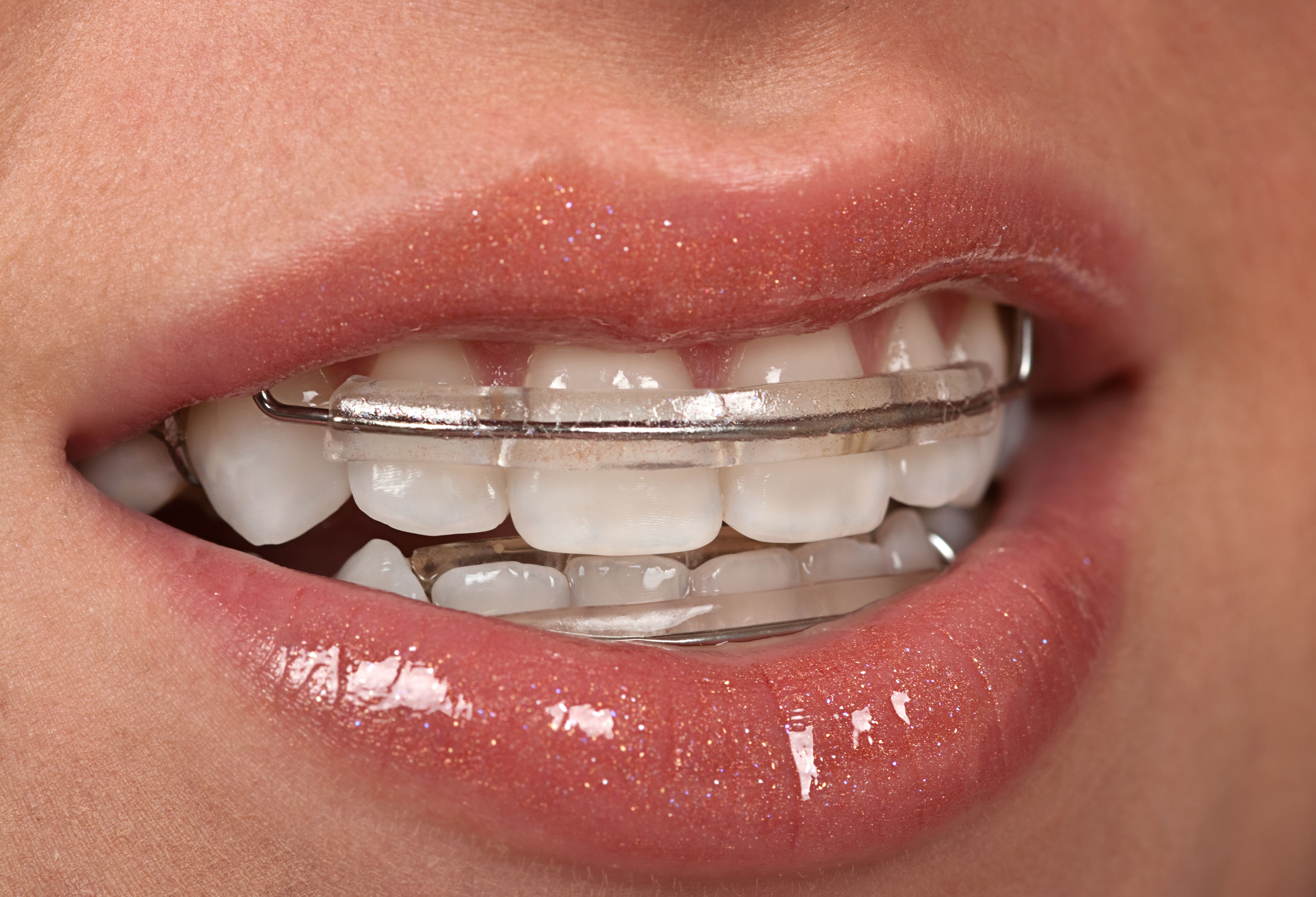 Поставили пластину на зубы. Ретейнер ортодонтический Капа. Пластинка ретейнер ортодонтическая.