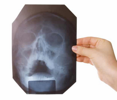 Рентген снимок пазух носа