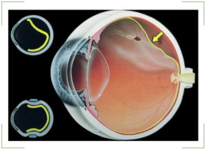 Периферическая дистрофия сетчатки глаза