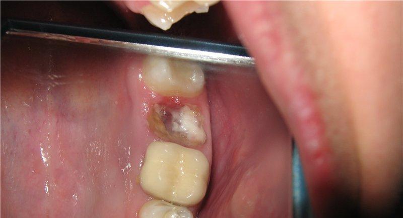 налет после удаления зуба