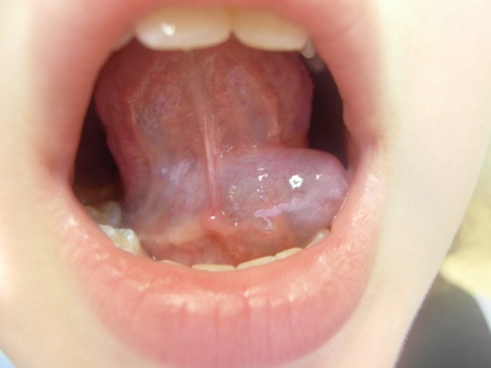Чем опасно воспаление под языком?