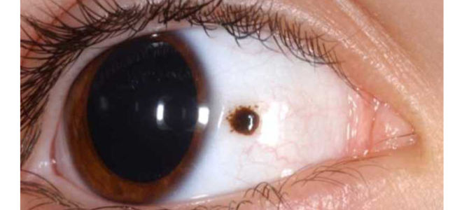 Онкология глаза