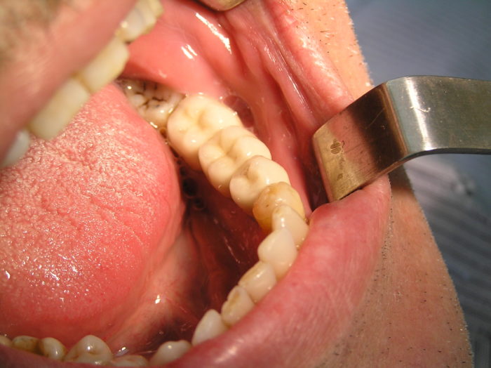 Как проводится лечение кисты челюсти?