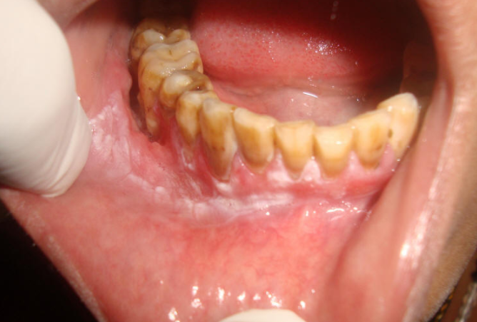 Лейкоплакия полости рта: причины, симптомы, формы патологии