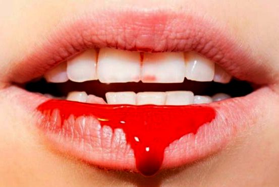 Причины крови изо рта