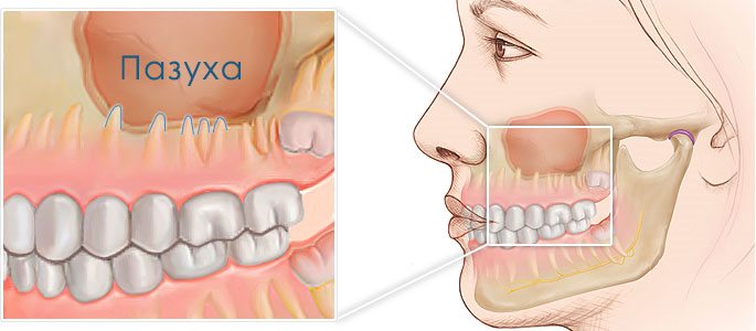 Перфорация гайморовой пазухи при удалении зуба: лечение