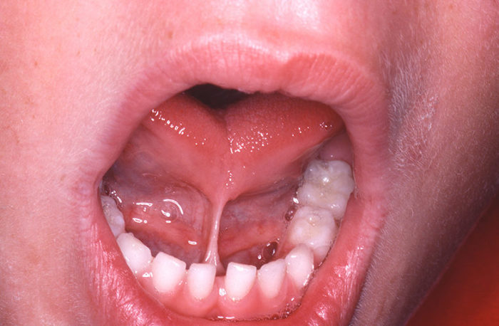 Как избавиться от шишки на уздечке под языком?