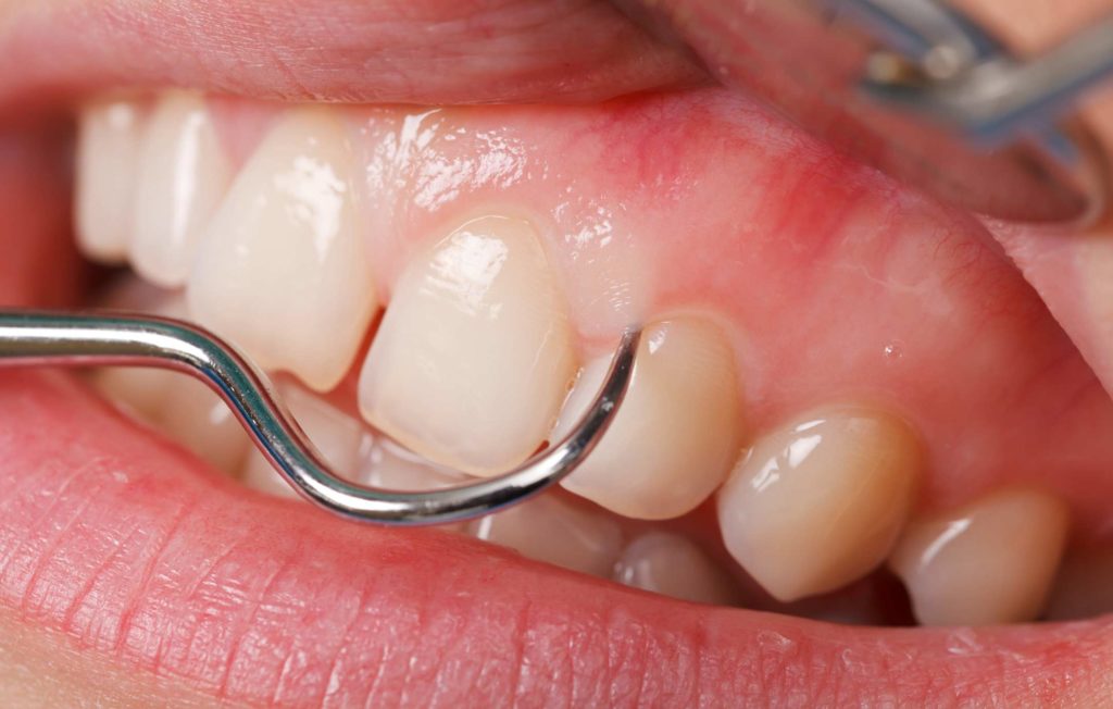 Через какое время после удаления зуба можно делать протезирование?