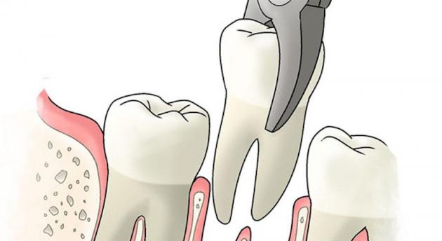 Сколько заживает десна после удаления зуба