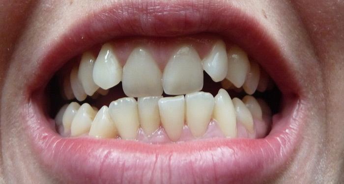 кривые зубы