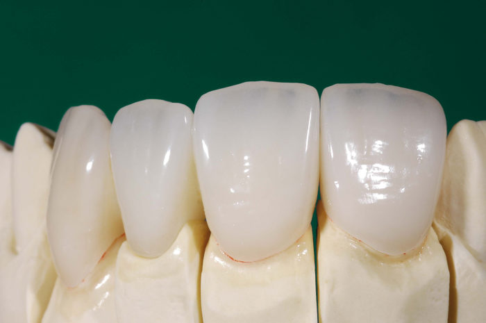 Что представляют собой керамические зубы?
