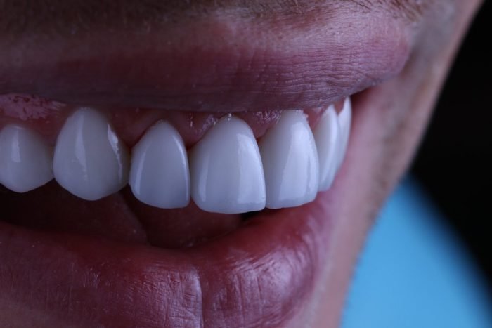 Виниры на зубы: как выбрать и какие лучшие?