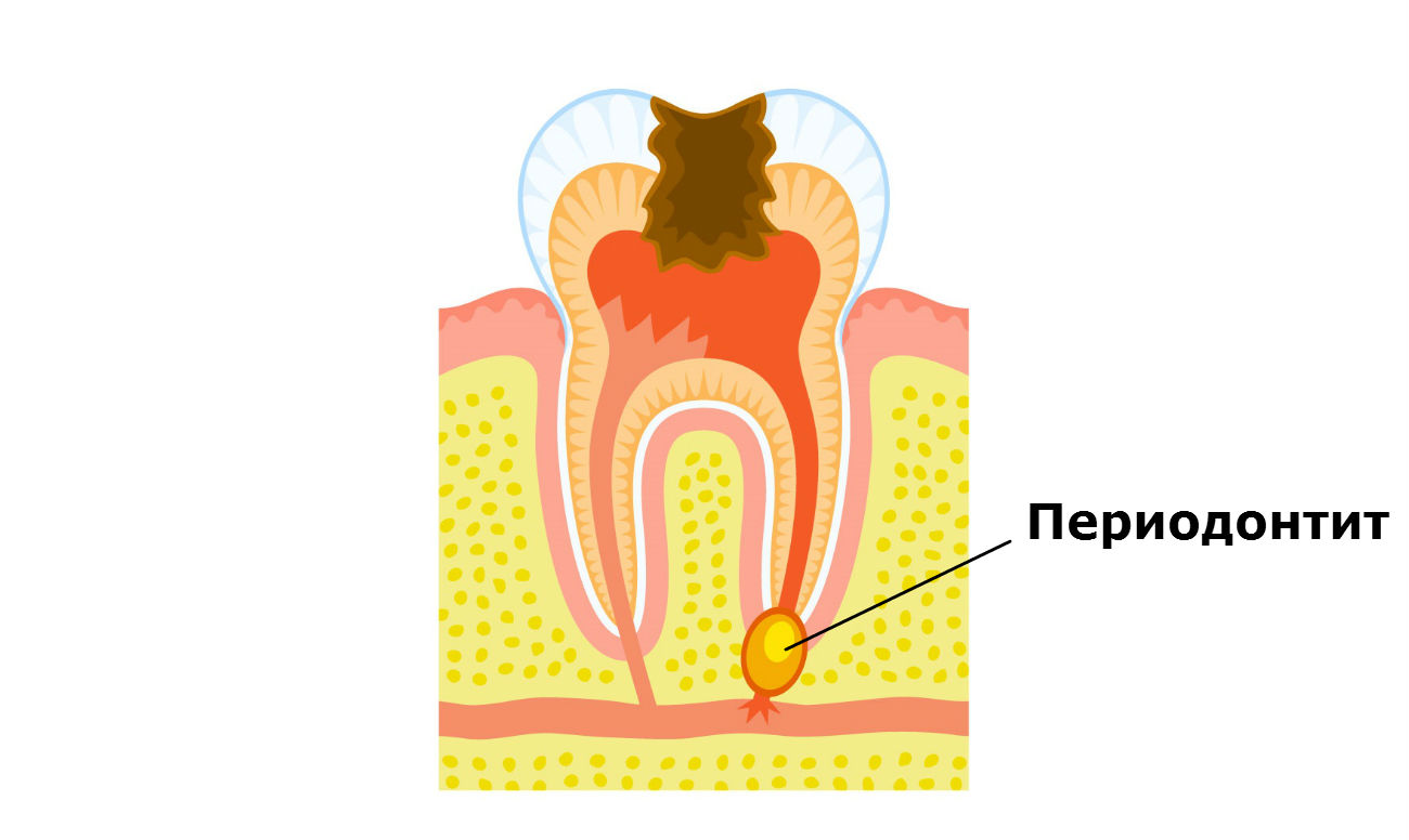 Осложнение лечения периодонтита. Воспаление зуба периодонтит. Апикальный периодонтит зуба. Хронический апикальный периодонтит. Апикальный (верхушечный) периодонтит.