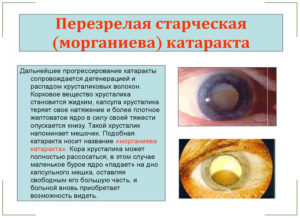 Сенильная (возрастная) катаракта