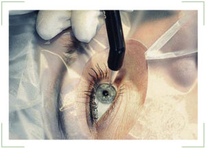 Лазерное лечение катаракты