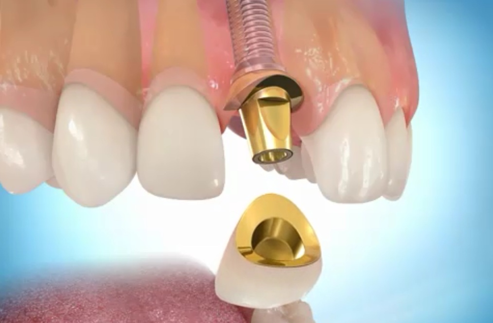 Протезирование передних зубов: разновидности процедуры и используемые материалы