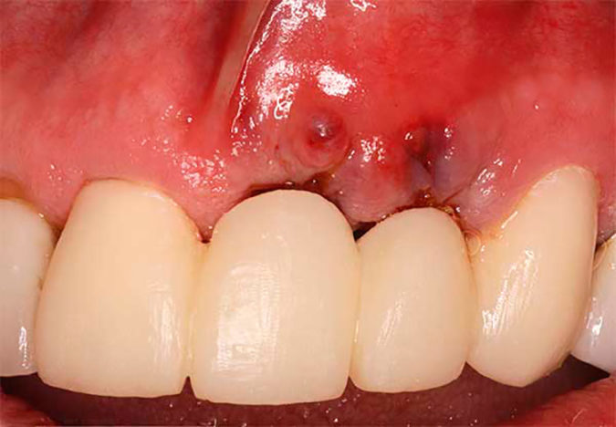 Как снять отек после имплантации зубов?