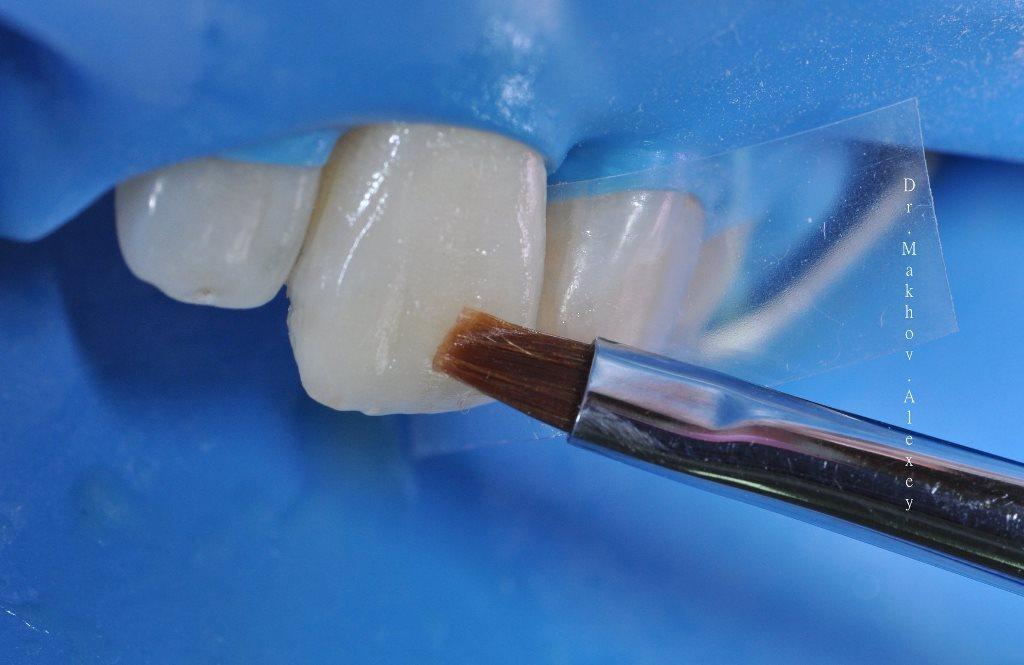 Композиты в стоматологии