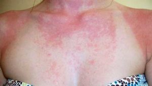 Аллергия от солнца