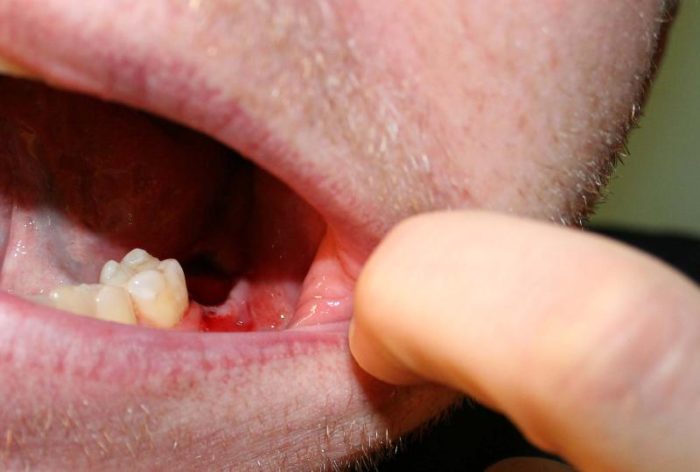 Почему после удаления зуба мудрости болит горло