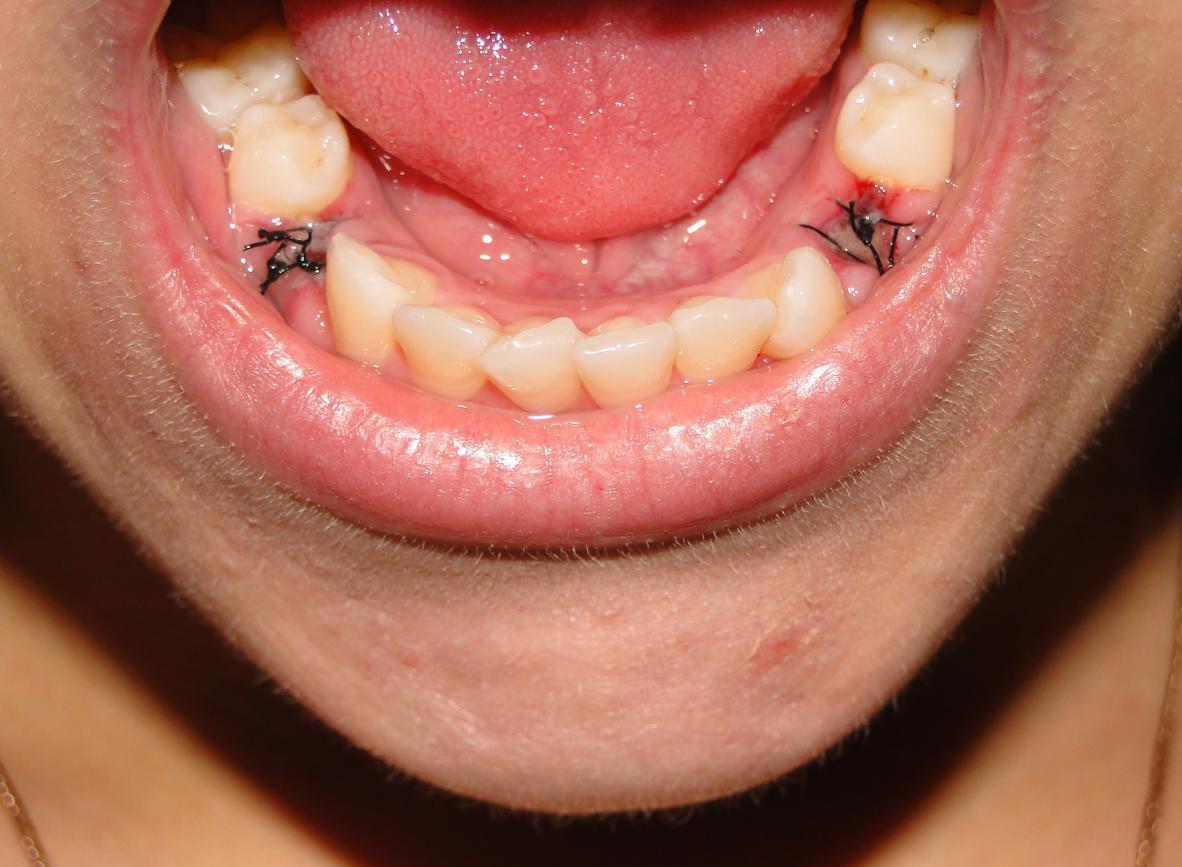 Может ли болеть соседний зуб после удаления thumbnail