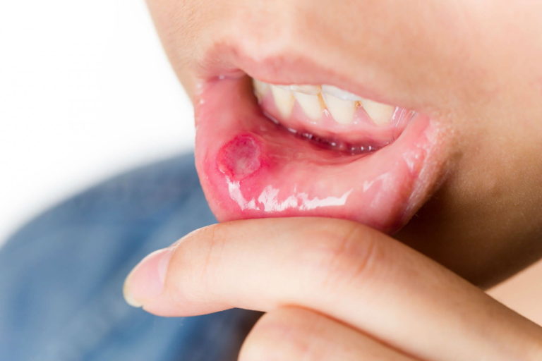 Заболевания полости рта