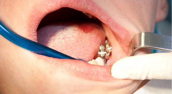 Удаление импланта зуба и показания к проведению операции