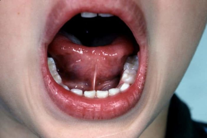 Для чего делается подрезание уздечки под языком у детей?