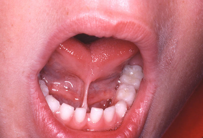 Чем опасно воспаление под языком?