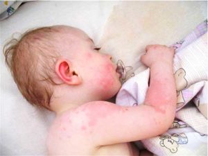 Аллергические высыпания у ребенка