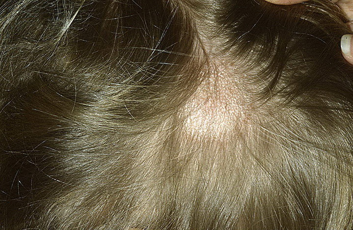 грибок на голове в волосах