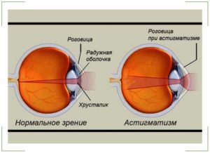 Рефракция глаза
