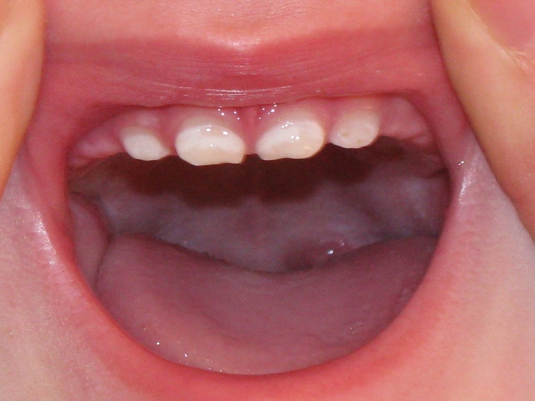 Крошатся зубы у ребенка
