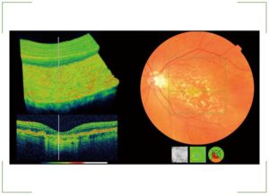 Оптическая когерентная томография глаза