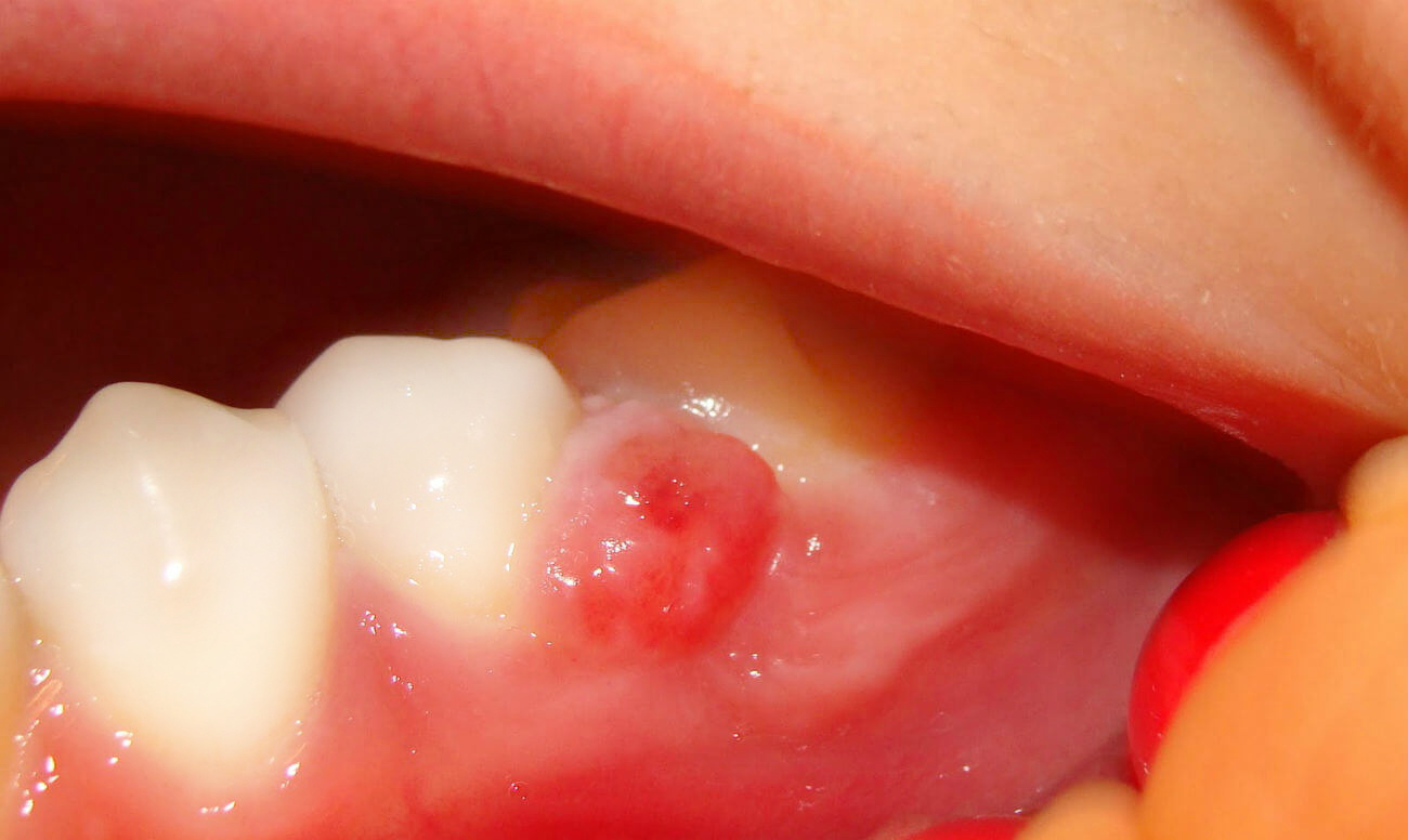 Лечение кисты зуба в домашних условиях