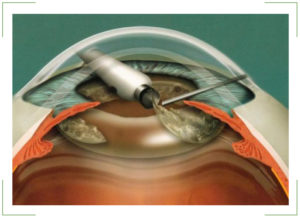 Сенильная (возрастная) катаракта