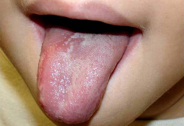У ребенка болит язык